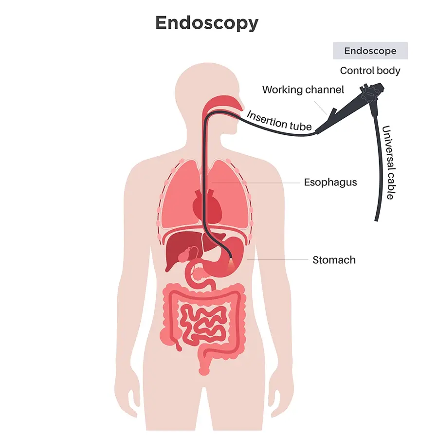 Image shows an endoscopy procedure with an endoscope inserting through the mouth and down into the stomach. 