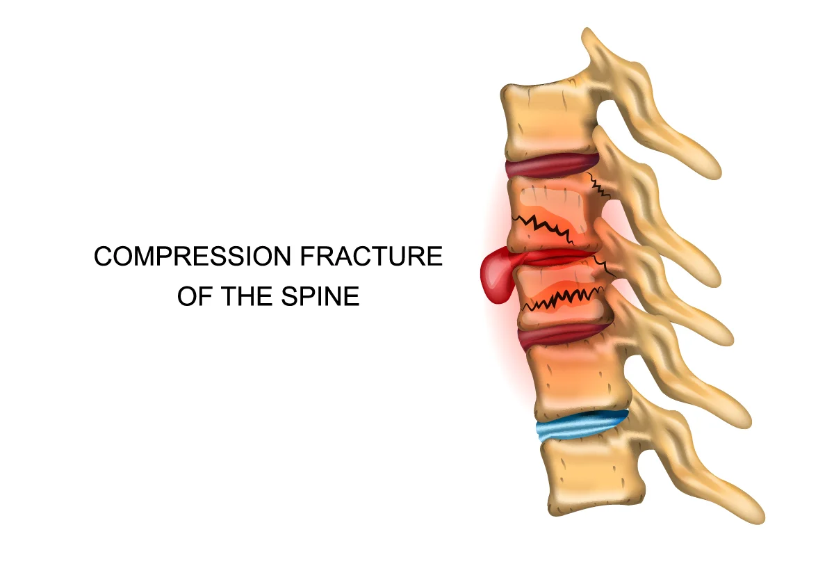 The above illustration shows a spinal compression fracture of two bones of the spine, commonly in the lower portion of the spine.