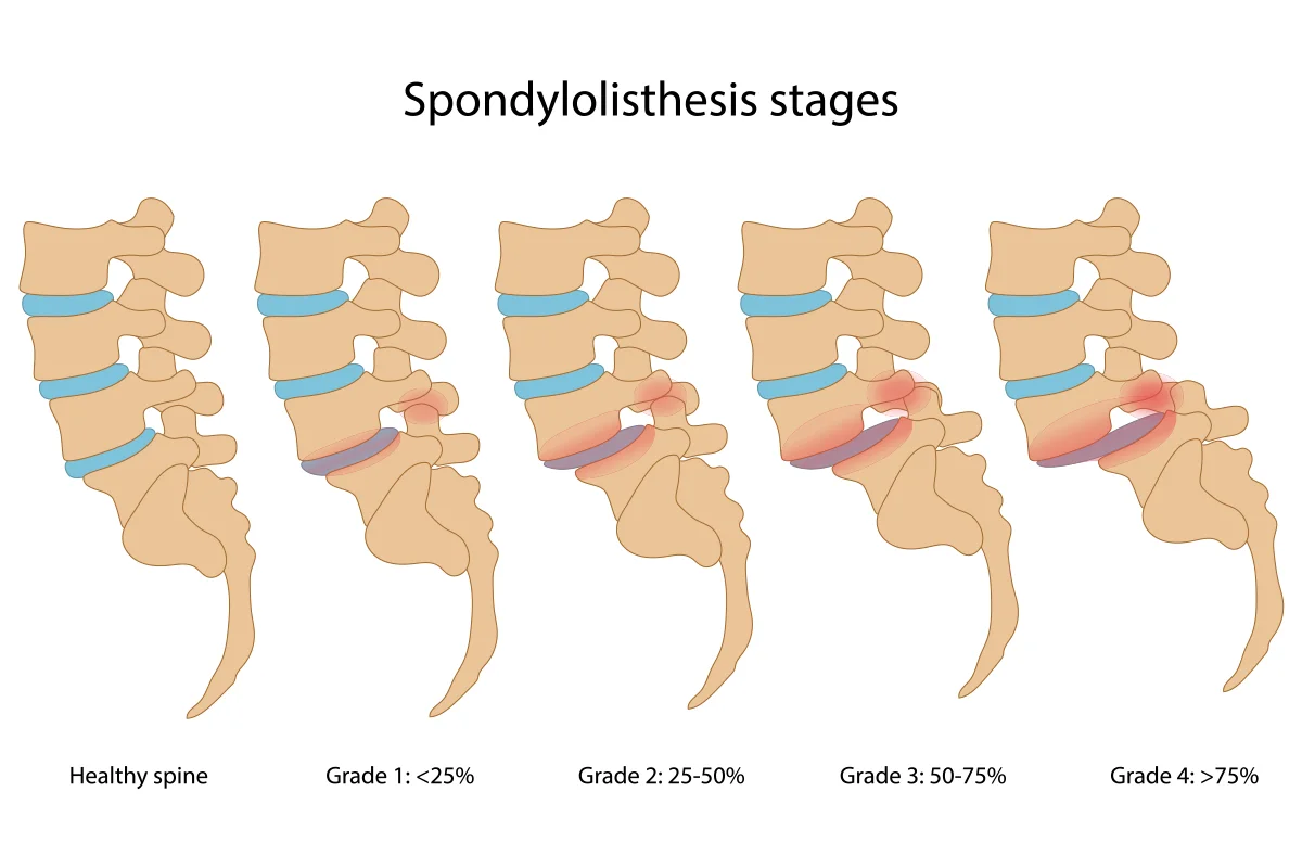 The image shows five different grades of vertebra position. It starts with healthy spine alignment and progresses to an image of more than 75% misalignment of the vertebra.