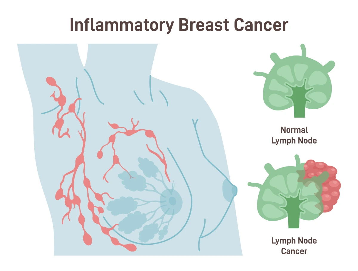 The image shows a lymph node that is infected with inflammatory breast cancer and a healthy lymph node.