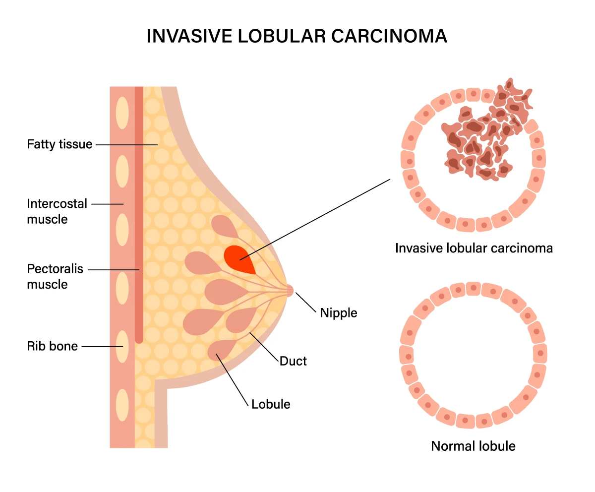 The image shows the difference between a normal milk gland in the breast tissue and one with invasive lobular carcinoma, where the cancer cells have spread outside the glands.