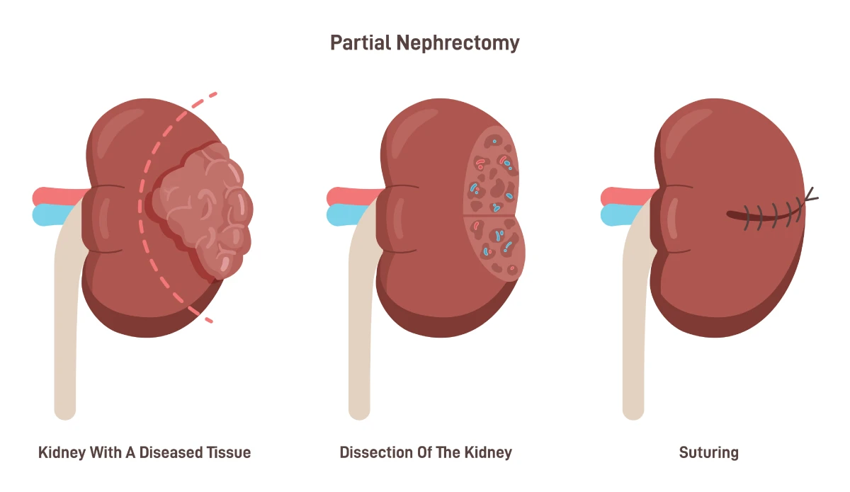 Rendering of partial nephrectomy