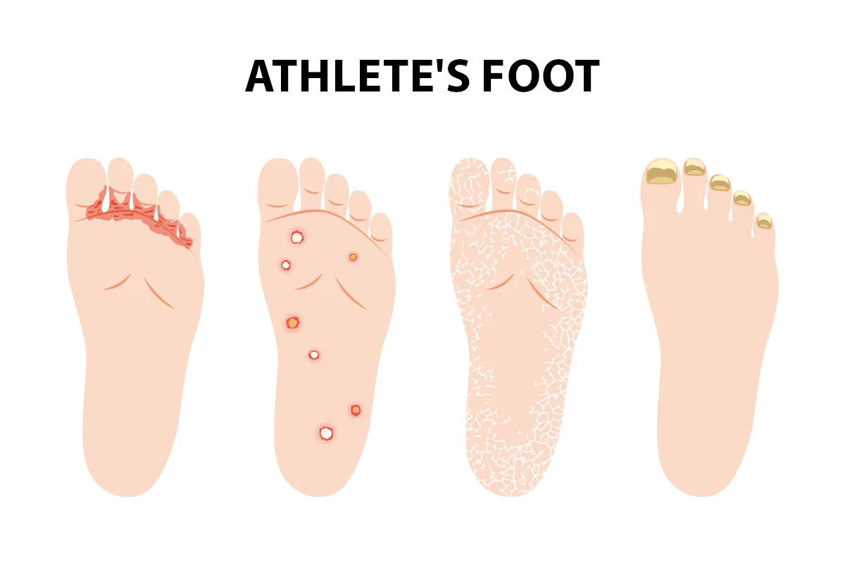 Image shows athlete’s foot symptoms, including red and irritated skin between your toes, round and red blisters on the soles of your feet, scaly and flaky skin, and infected toenails.