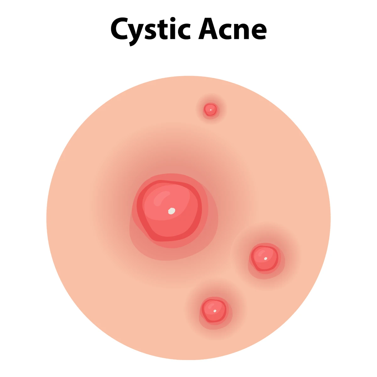 The image illustrates what cystic acne looks like, with deep, red lumps that are swollen with a visible whitehead.