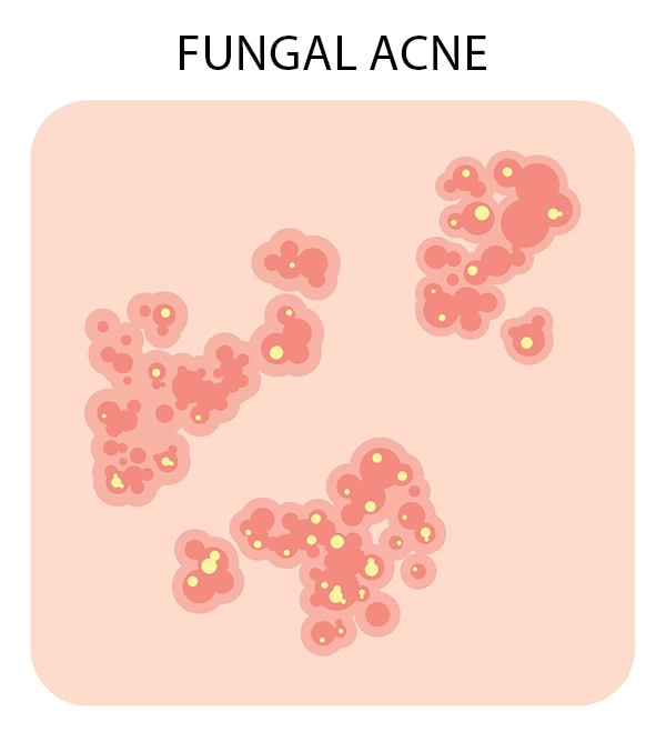 Image shows a fungal acne breakout, with clusters of red or pink bumps that may turn into whiteheads.