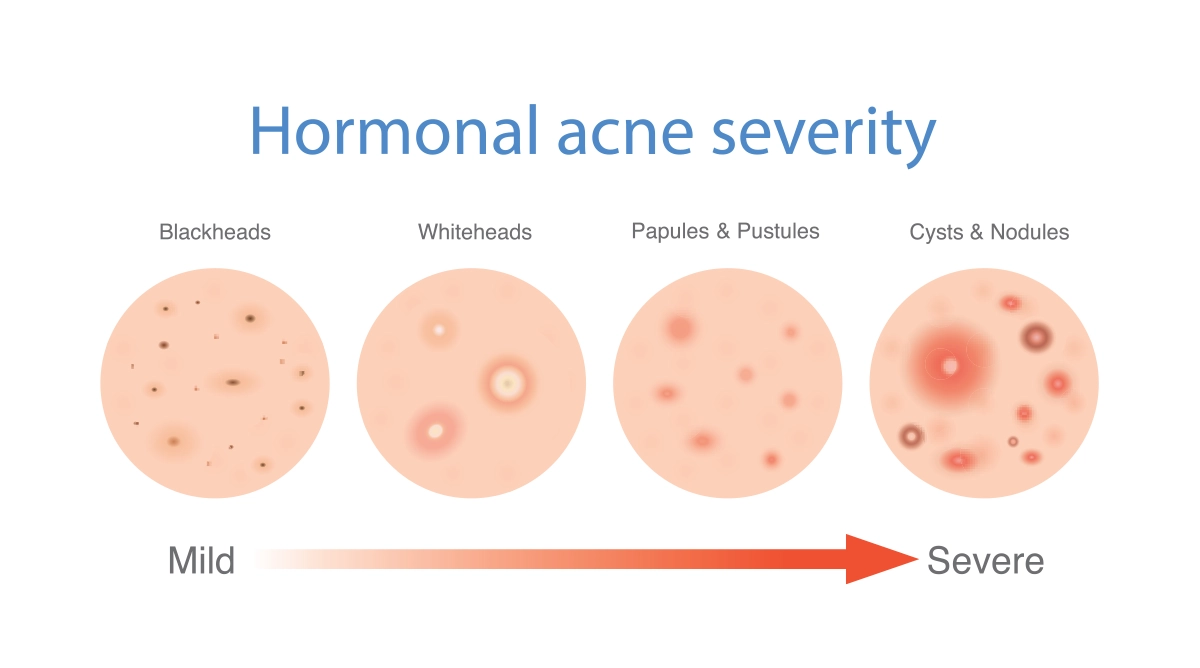 Image shows the types of hormonal acne, and their severity, including blackheads, whiteheads, papules, pustules, nodules and cysts.