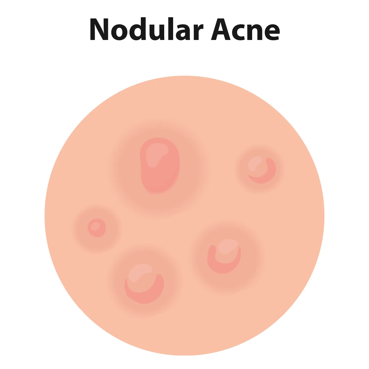 Image illustrates nodular acne pimples, which appear as dark red or purple bumps on the surface of the skin with a deeper lump beneath it.