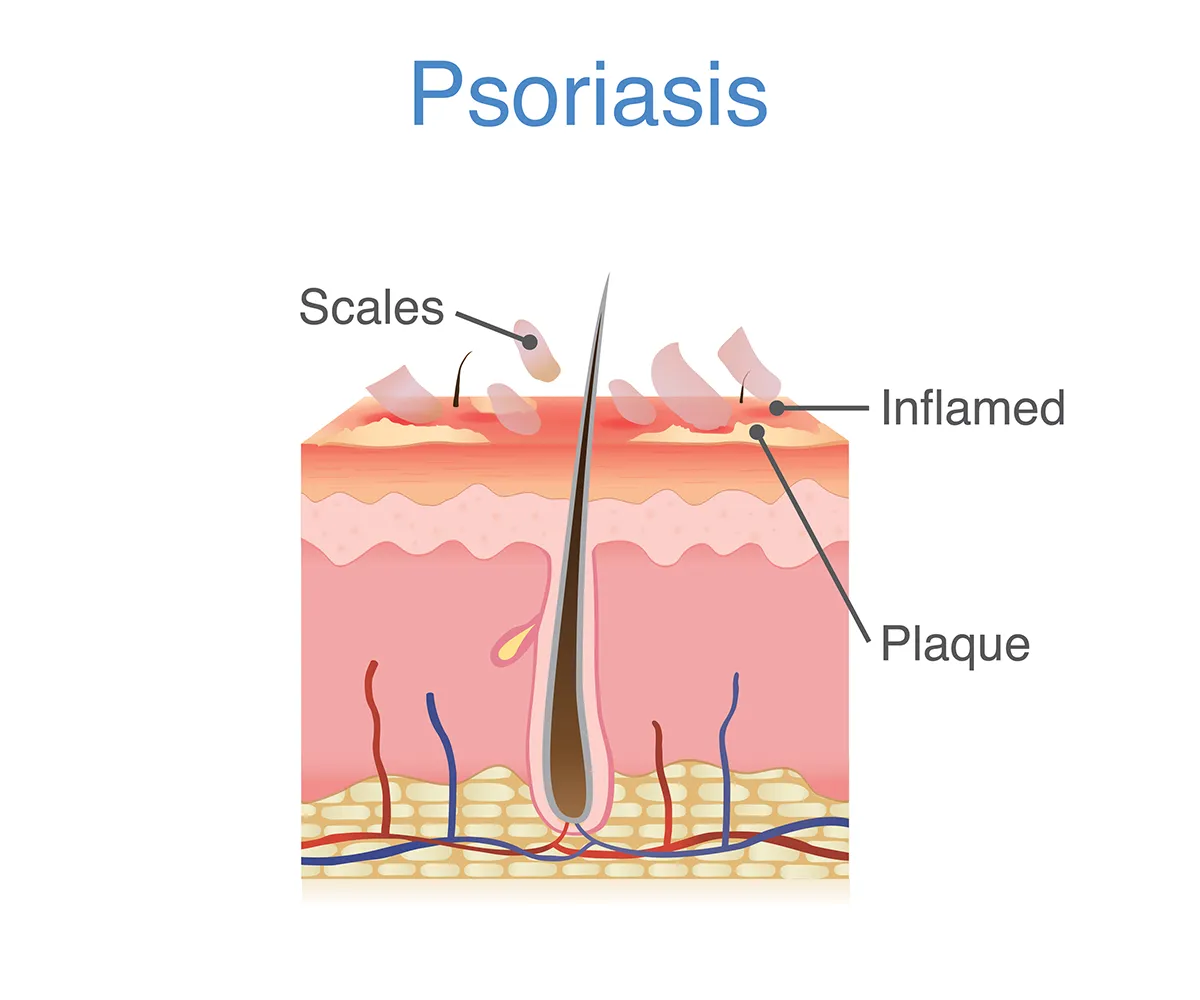 The image shows the layers of skin affected by psoriasis, including symptoms of inflamed, discolored and scaly skin (plaque).
