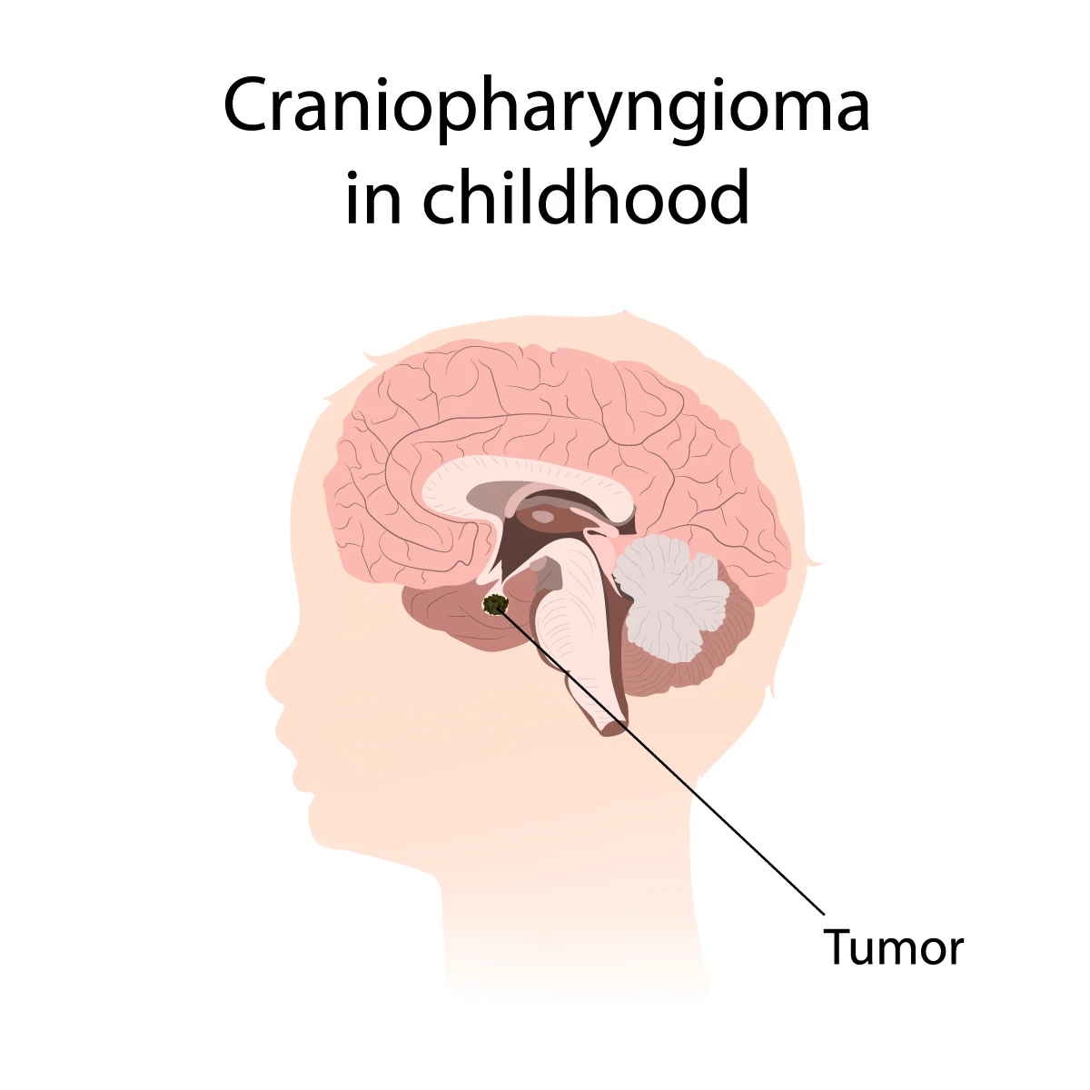 Image of craniopharyngioma tumor in a child's head.