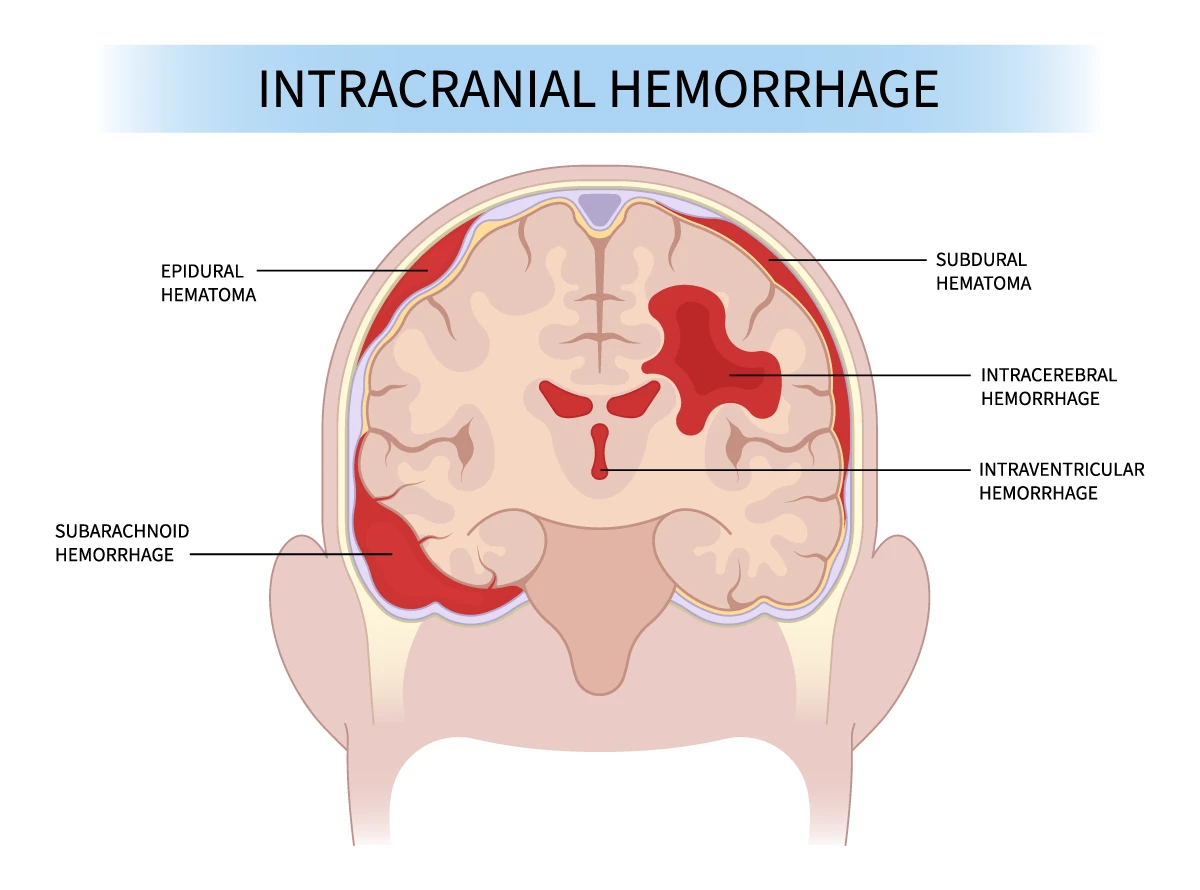 The image shows the types of brain hemorrhage and their locations in the brain