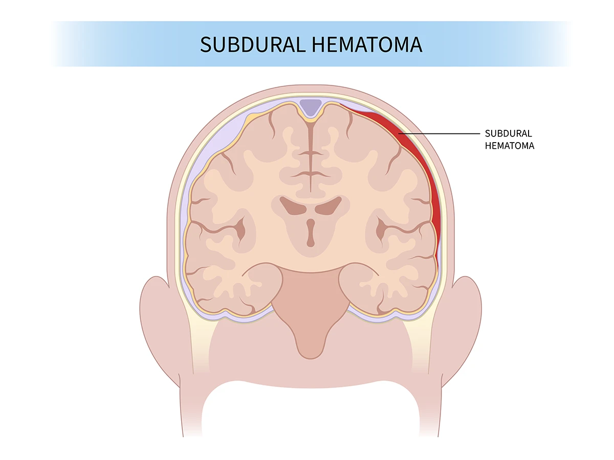 The image shows the location of a subdural hemorrhage in the brain