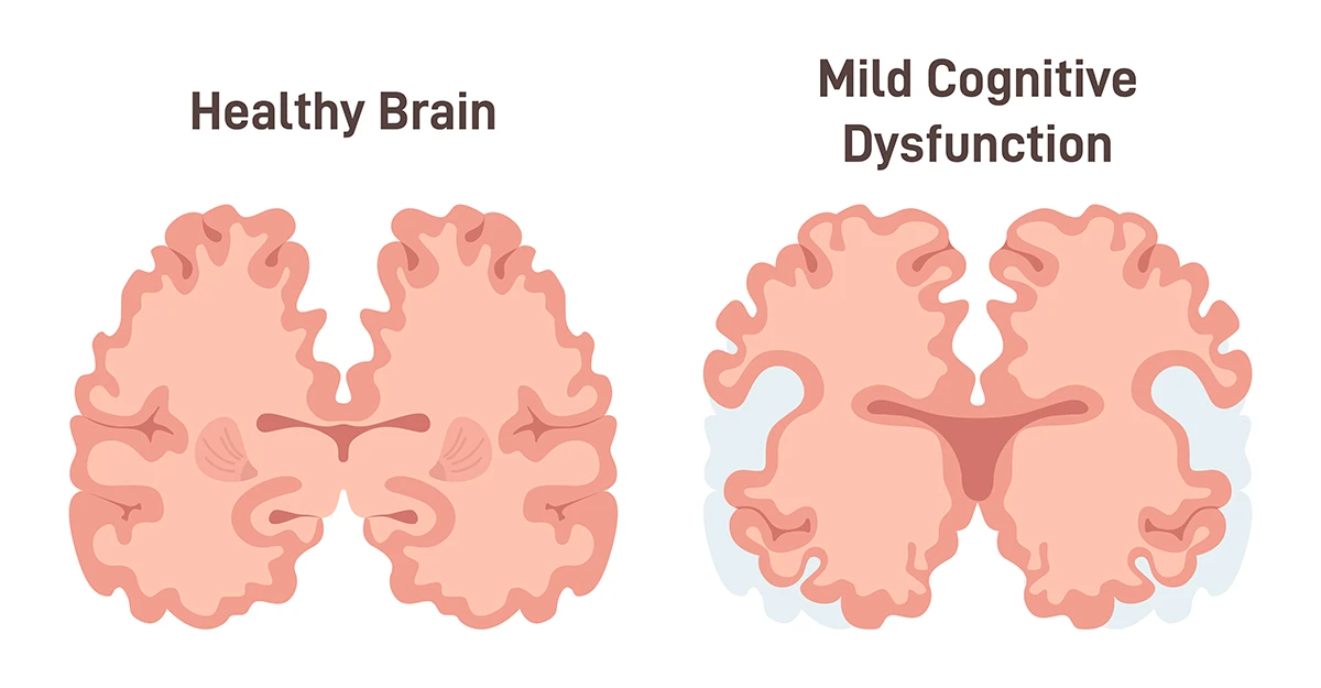 Illustration of a healthy brain in comparison with a brain with mild cognitive impairment (MCI).