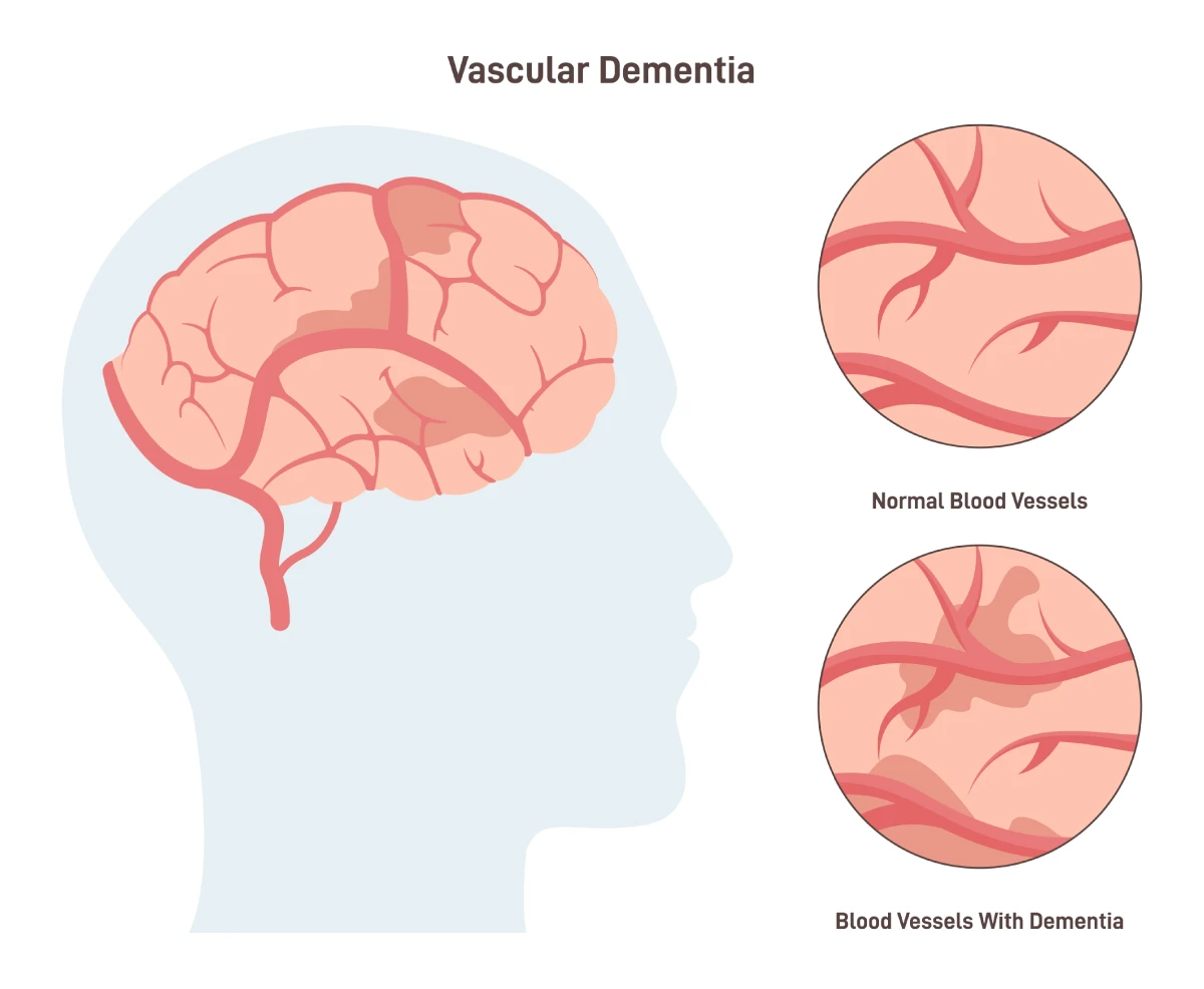 Image shows your brain’s blood vessels impacted by vascular dementia compared with healthy blood vessels.