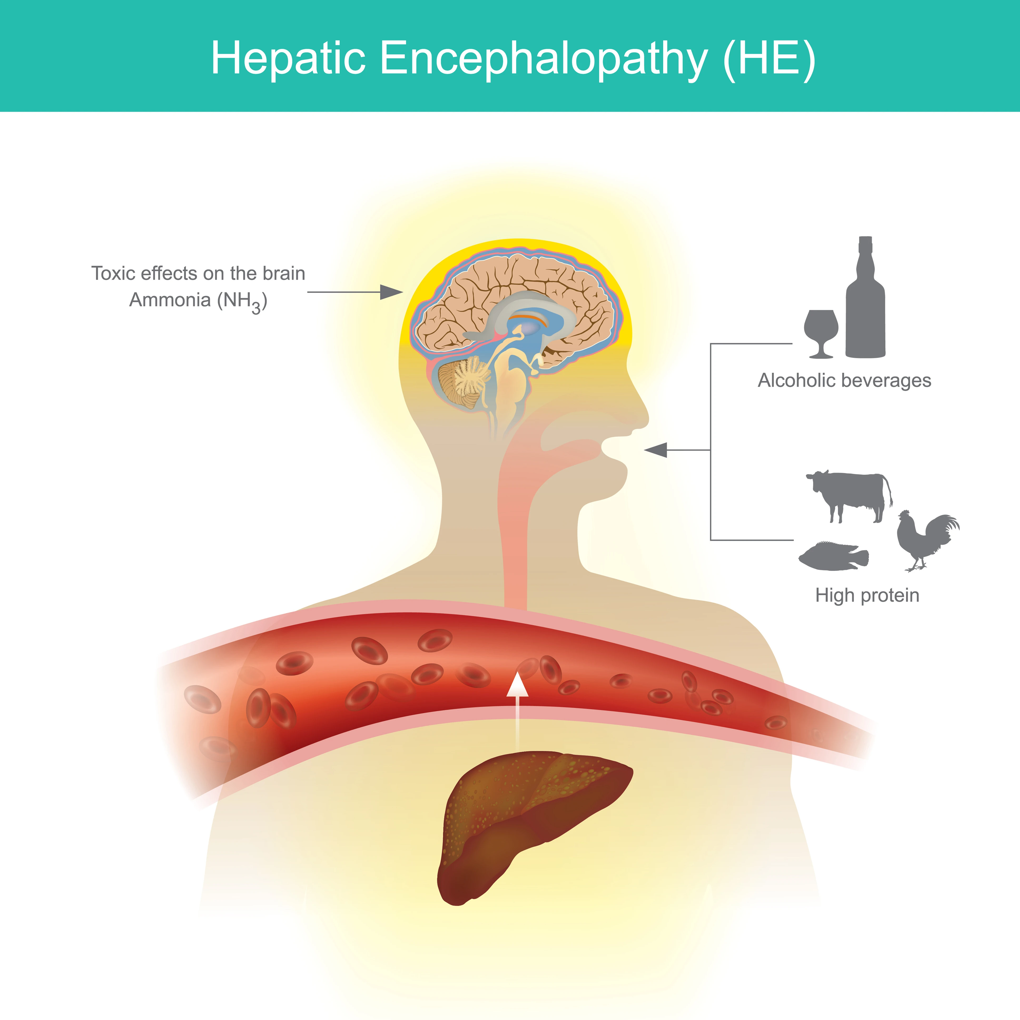 Hepatic encephalopathy is caused by toxins affecting the brain and may be a result of excessive alcoholic beverages and high levels of protein.