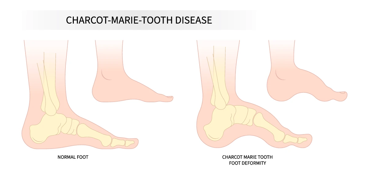 The image shows the difference between a normal foot and a foot with Charcot-Marie-Tooth disease