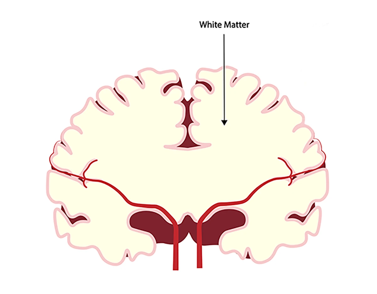 Image shows white matter in the brain, the area affected by leukodystrophies, as viewed from the top of the brain.