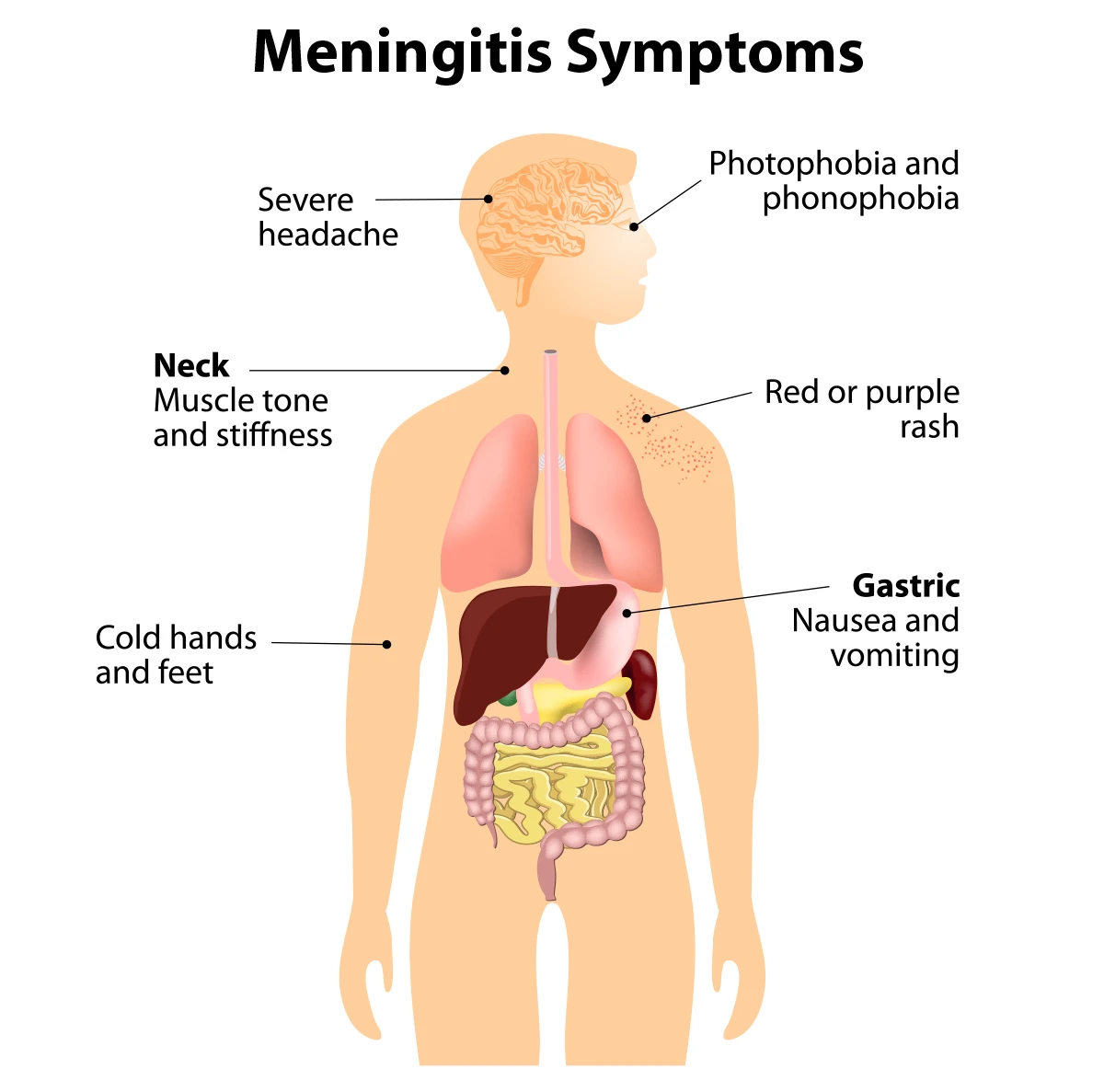 Image displays common symptoms of meningitis