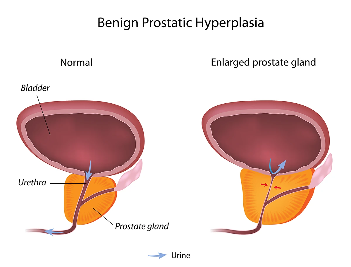 Benign prostatic hyperplasia diagram