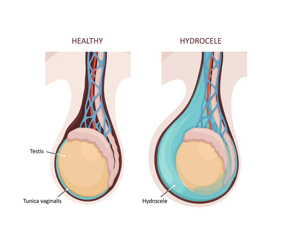 Hydrocele diagram