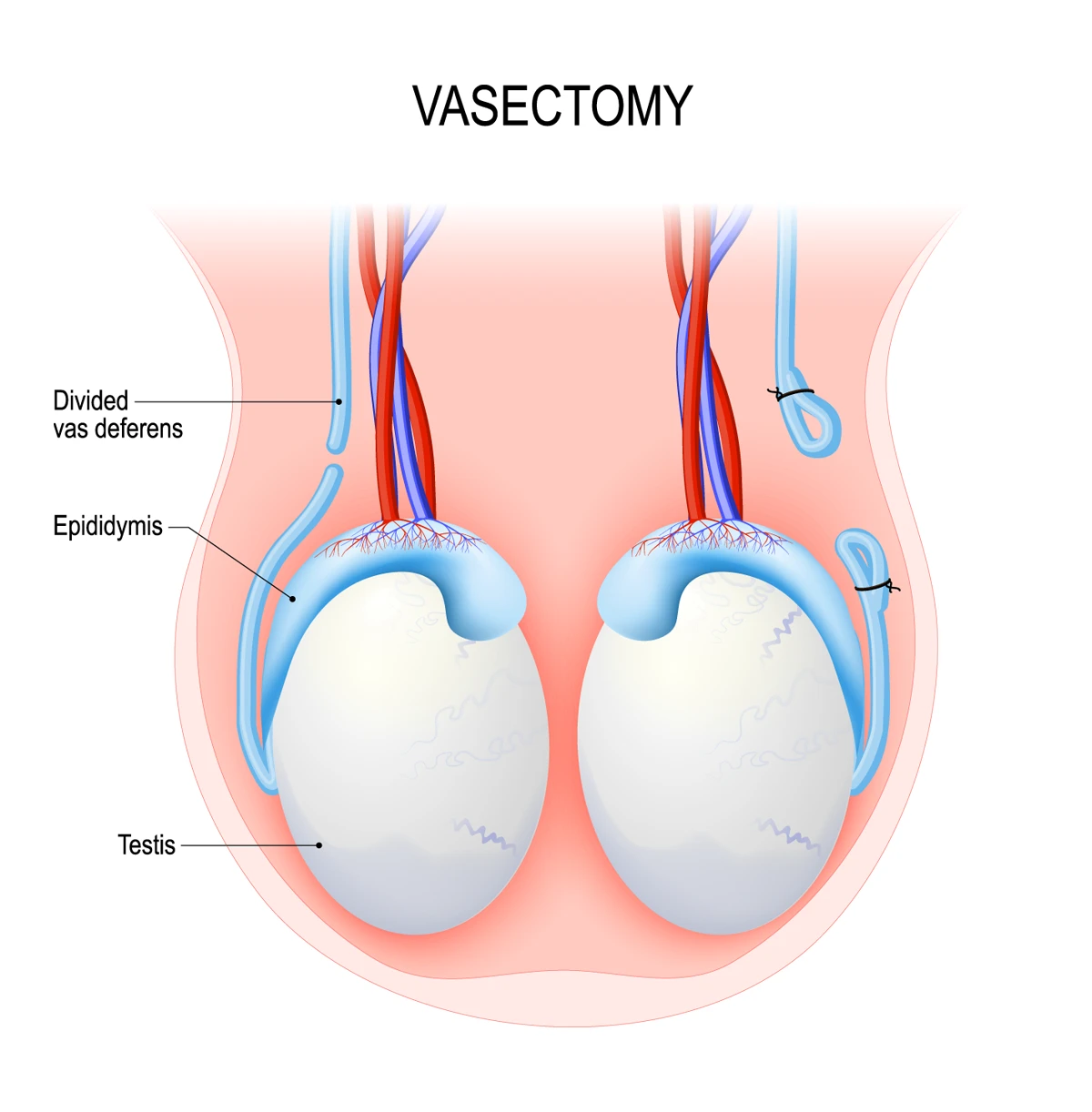 No scalpel vasectomy